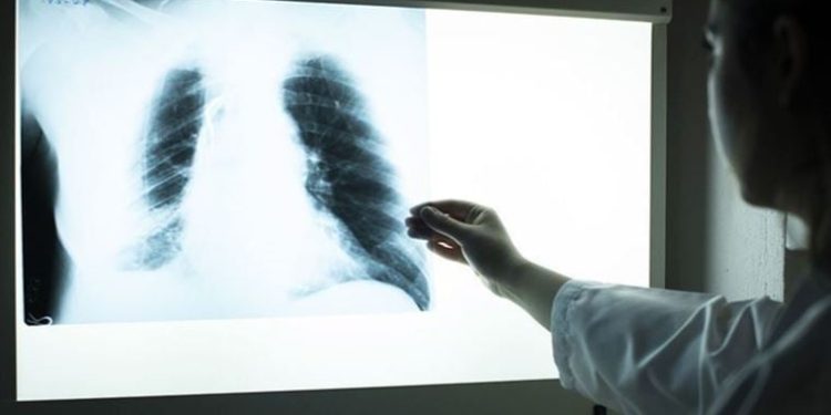 Covid-19’dan sonra en fazla ölüme neden olan hastalık belli oldu