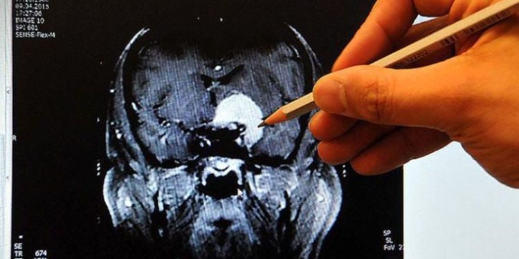 Prof. Dr. Nuri Tutar: ‘Ayakta başlayan pıhtı ölüme kadar götürebilir’