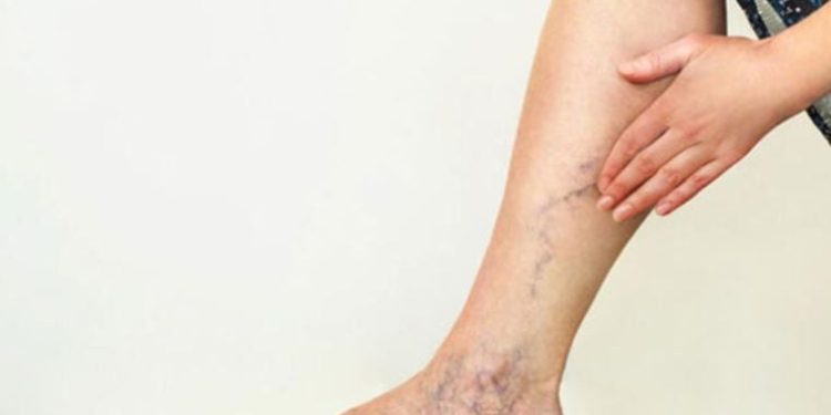 Radyoloji uzmanı uyardı: Varis, en çok o meslek gruplarını etkiliyor