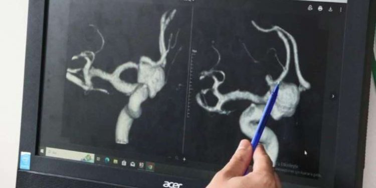 Uzmanlar anlattı: Beyin anevrizmasının tedavi süreci