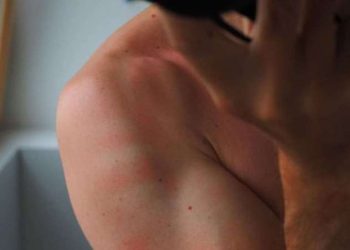 Uyuz nedir, nasıl bulaşır? Uyuzun belirtileri nelerdir? Uyuzun tedavisi nedir?