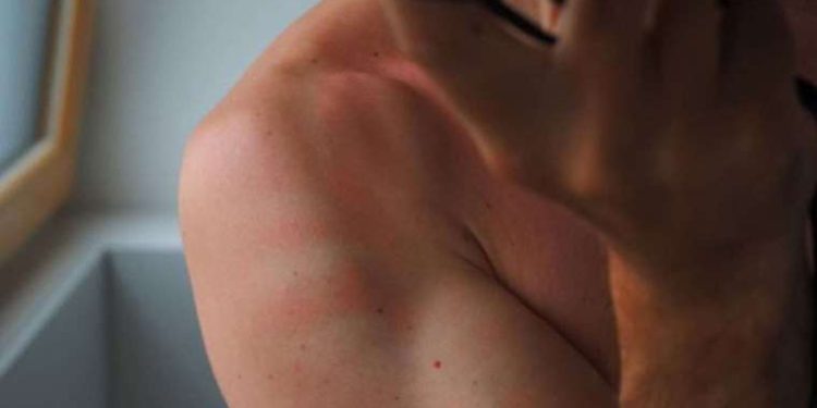 Uyuz nedir, nasıl bulaşır? Uyuzun belirtileri nelerdir? Uyuzun tedavisi nedir?