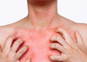 Uyuz hastalığından nasıl korunabiliriz?